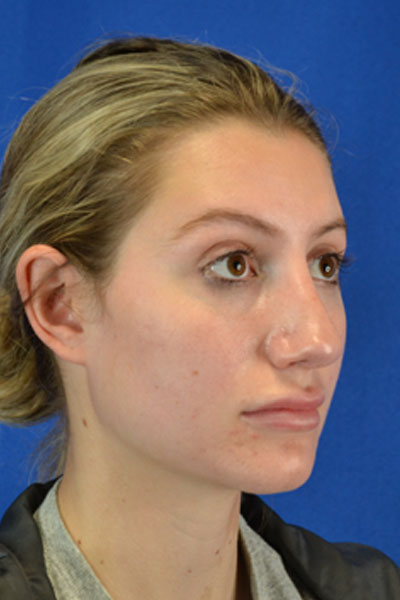 Revision Rhinoplasty case #3575