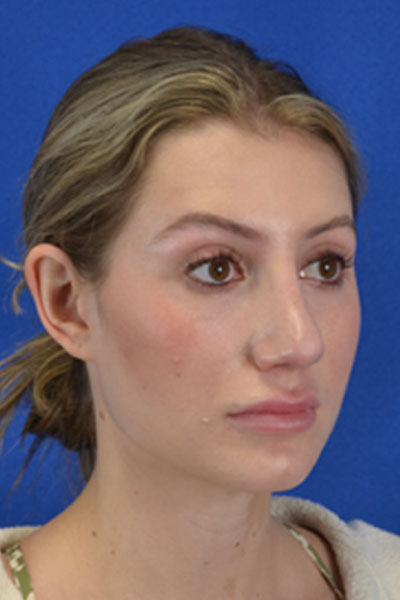 Revision Rhinoplasty case #3575