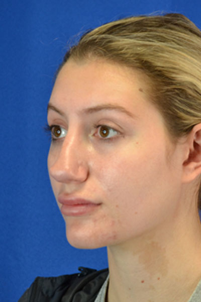 Revision Rhinoplasty case #3575