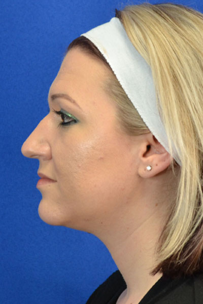 Rhinoplasty case #3503