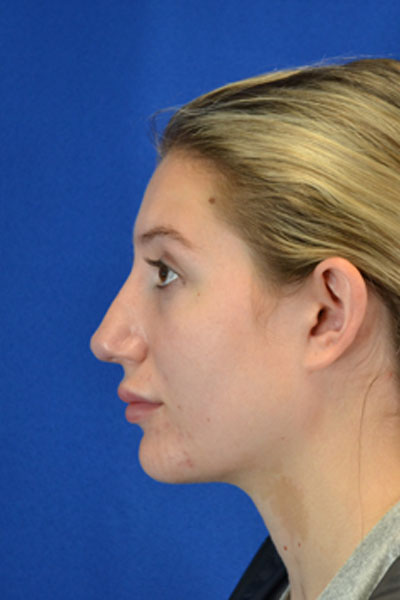 Revision Rhinoplasty case #3575