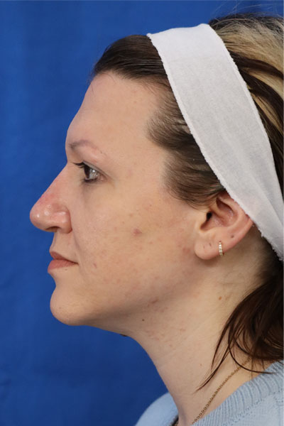 Rhinoplasty case #3503