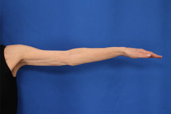 Arm Lift case #5503