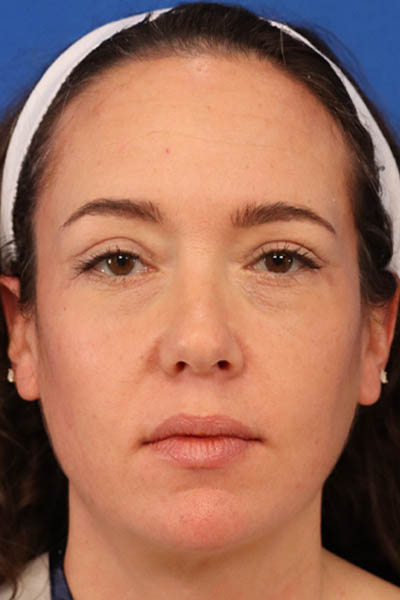 Blepharoplasty case #5591