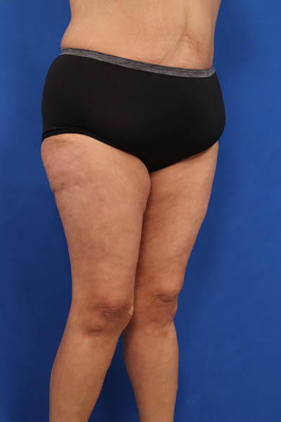 Thigh Lift case #5532