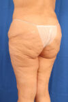 Thigh Lift case #5532